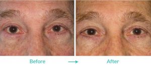 eyelid turning in procedure eyesthetica