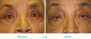 eyesthetica entropion repair surgery los angeles