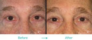 eyelid turning in procedure eyesthetica2