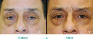 eyelid turning in repair