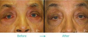 Turning in eyelid surgery