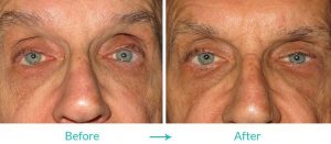 best eyelid turning in procedure in california