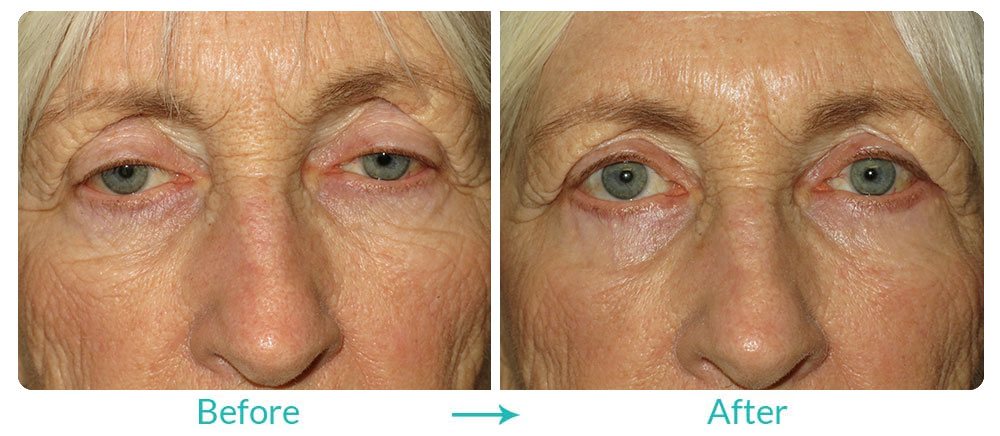 Ptosis and lower eyelid surgery