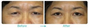 droopy-eyelids-and-upper-blepharoplasty-repair-case-243