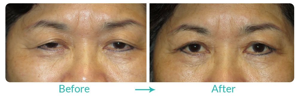 Case 243 before and after ptosis surgery