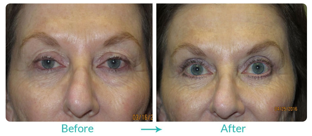 ptosis and blepharoplasty surgery