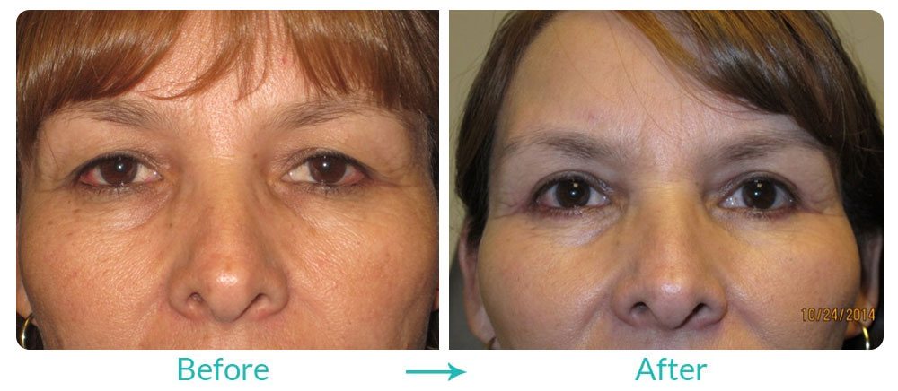 multiple eyelid deformation treatment