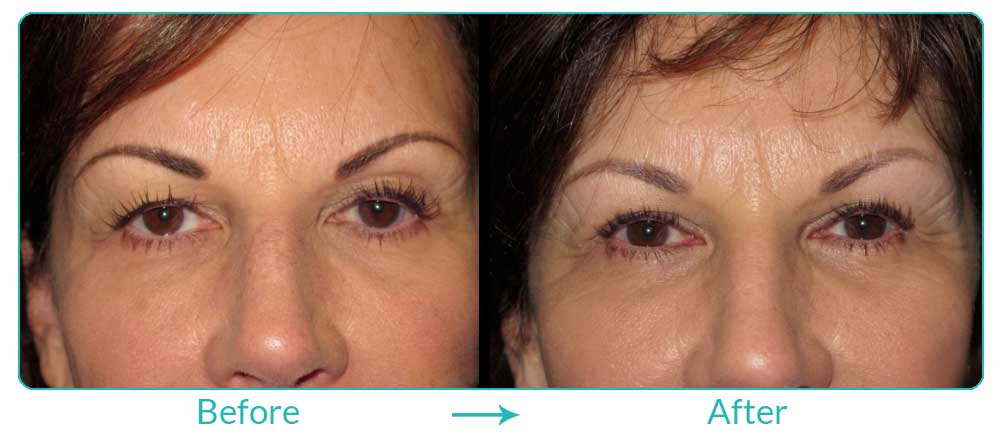 droopy eyelids procedure