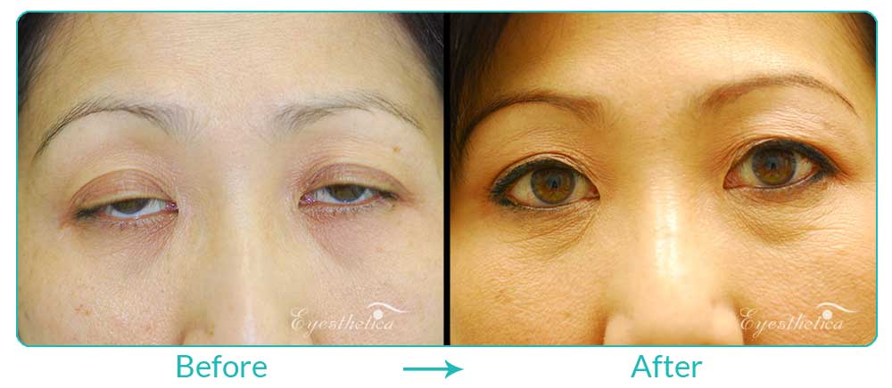 Ptosis treatment for asians
