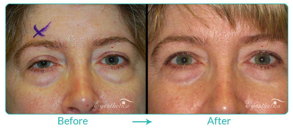 ptosis treatment for droopy eyelids