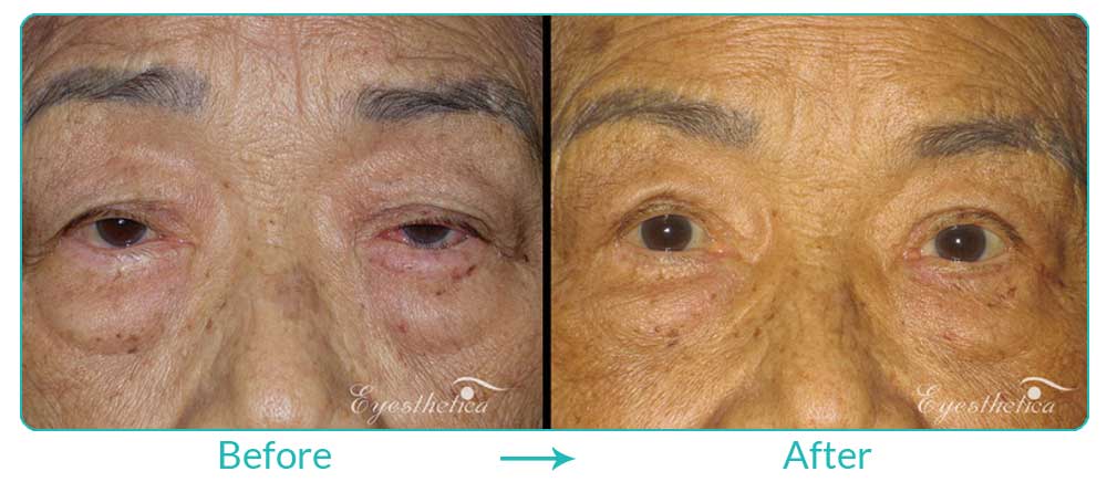 upper eyelid surgery