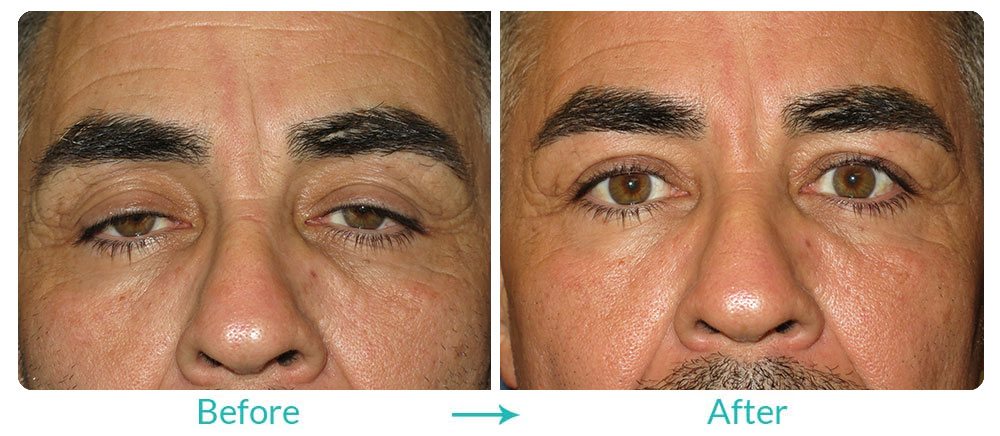 Ptosis repair for men