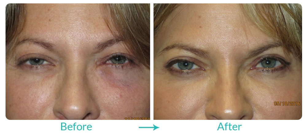 professional ptosis repair