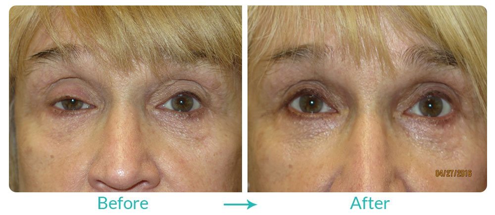 best Ptosis repair treatment in california