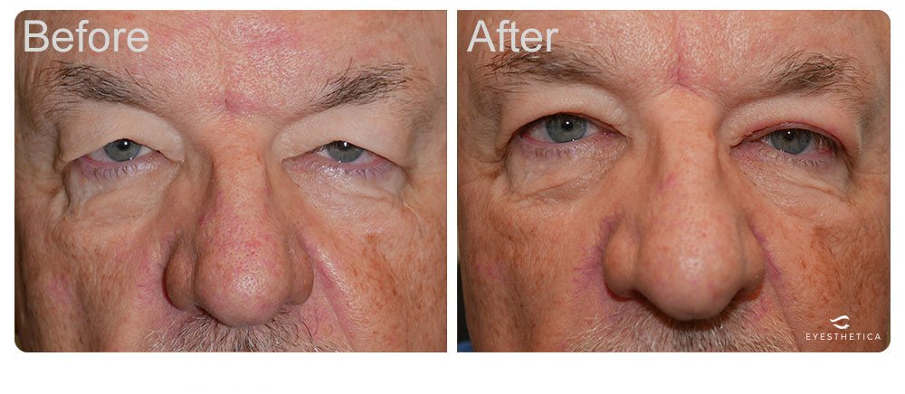 droopy eyelid treatment before and after surgery