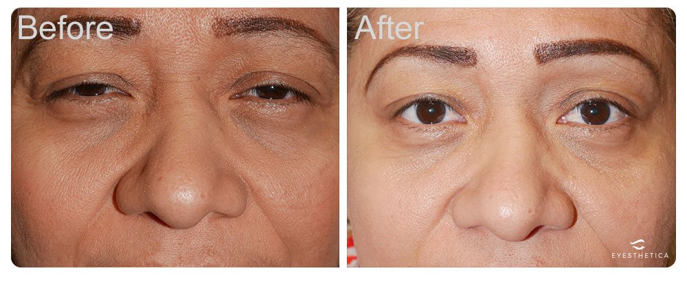 los angeles ptosis procedure for droopy eyelids