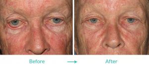 eyelid turning out surgery in eyesthetica