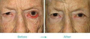 eyelid turning out surgery eyesthetica