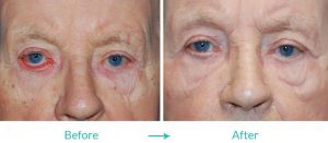sagging lower eyelid surgery