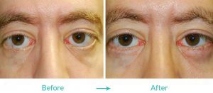eyelids turning out procedure