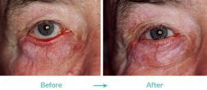 ectropion repair treatment procedures