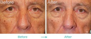 Eyelid Turning Out Procedure