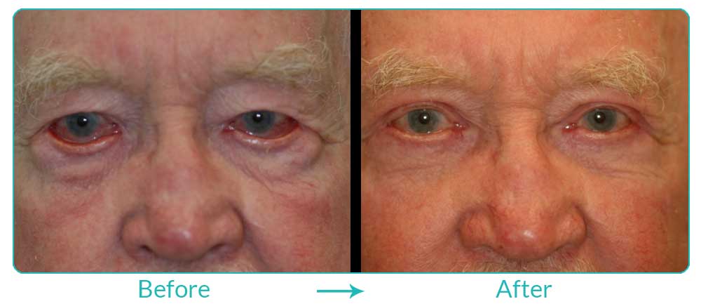 eyelid turning out procedure