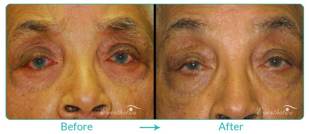 Turning in eyelid surgery