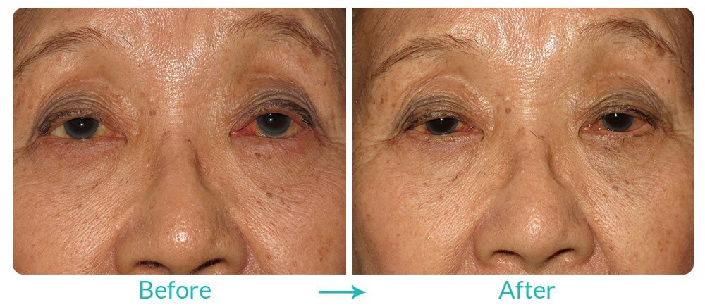 turning in eyelid repair