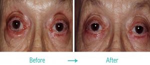 eyesthetica entropion surgery