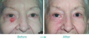 eyelid tumor repair in california