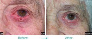best eyelid tumor repair reconstruction