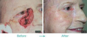 best eyelid tumor repair