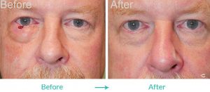Eyesthetica with Moh Surgeons Collaboration to Remove Eyelid Tumor