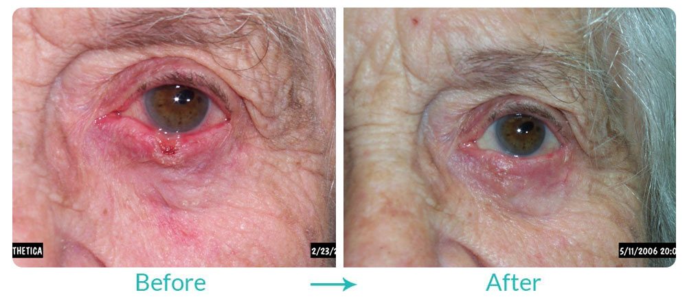 best eyelid tumor repair reconstruction