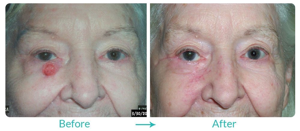 eyelid tumor repair in california