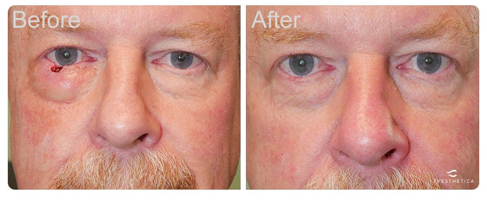 eyesthetica with Moh surgeons collaboration to remove eyelid tumor