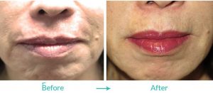 best fillers and laser surgery in California