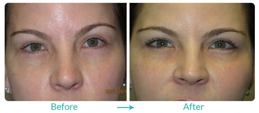 Fillers and Laser surgery case-247