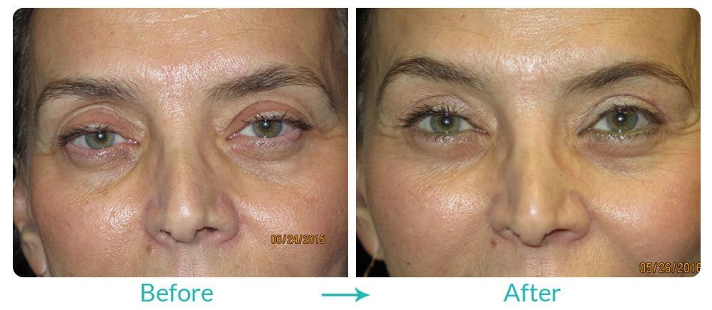 fillers and droopy eyelids surgery