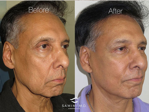 Middle-aged man before and after facelift