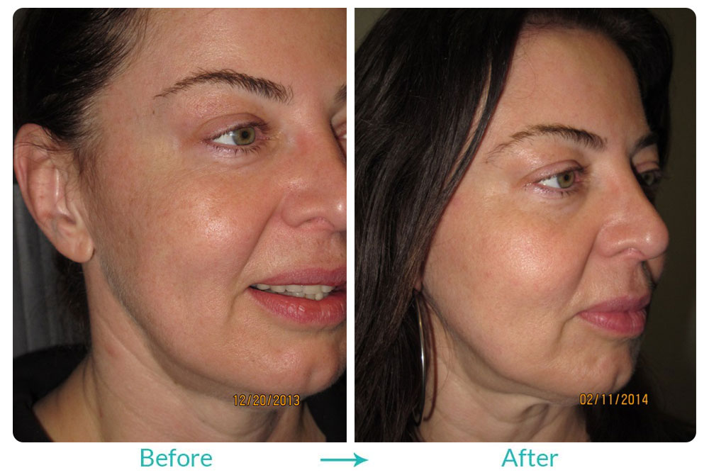 eyesthetica laser resurfacing