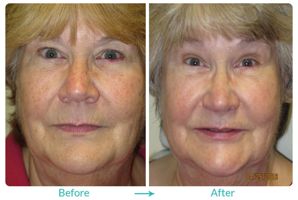 skin rejuvenating laser procedure