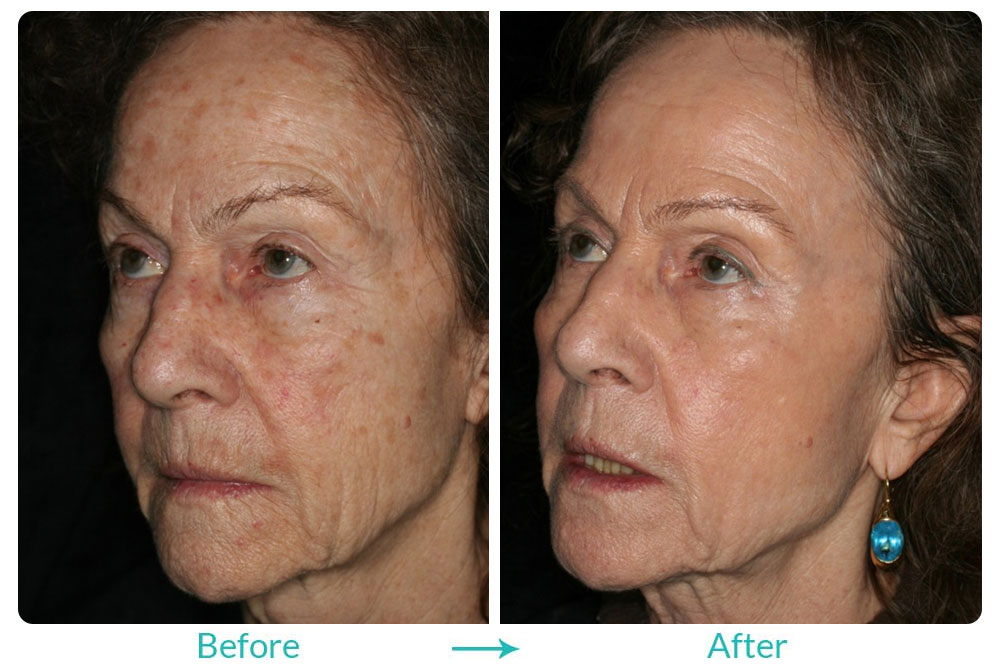 Active FX laser resurfacing x2