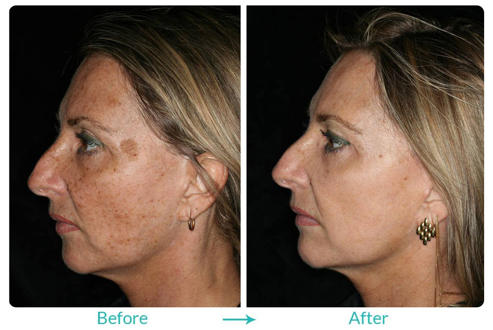 Case 257 best laser procedure in Los Angeles