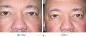 under eye skin aging treatment