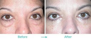 best lower eyelid surgery in Los Angeles