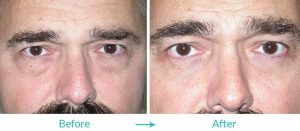 eye bag removal surgery
