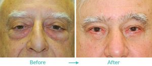 Under eye bags surgery
