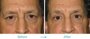 blepharoplasty for upper eylids and lower eyebags